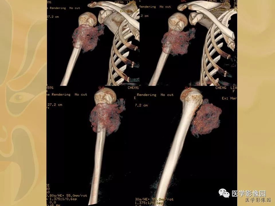 【病例】骨化性肌炎1例X线CT及MR影像表现