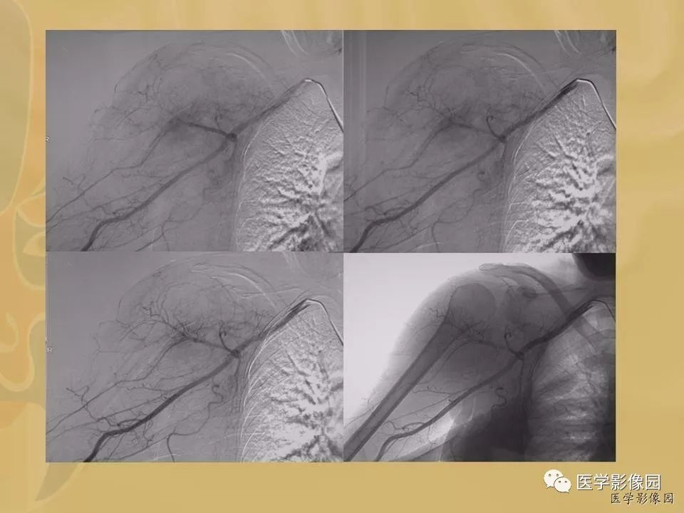 【病例】骨化性肌炎1例X线CT及MR影像表现