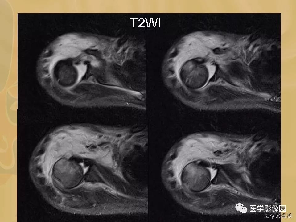 【病例】骨化性肌炎1例X线CT及MR影像表现