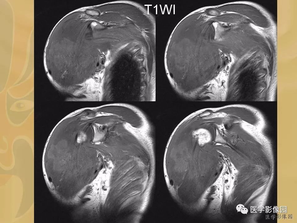 【病例】骨化性肌炎1例X线CT及MR影像表现