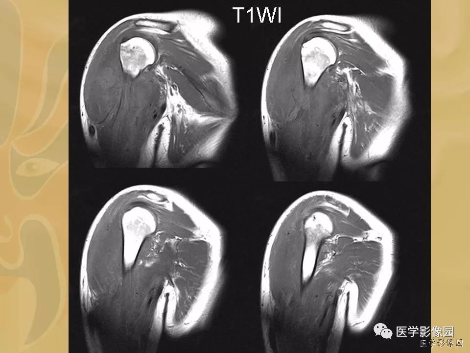 【病例】骨化性肌炎1例X线CT及MR影像表现