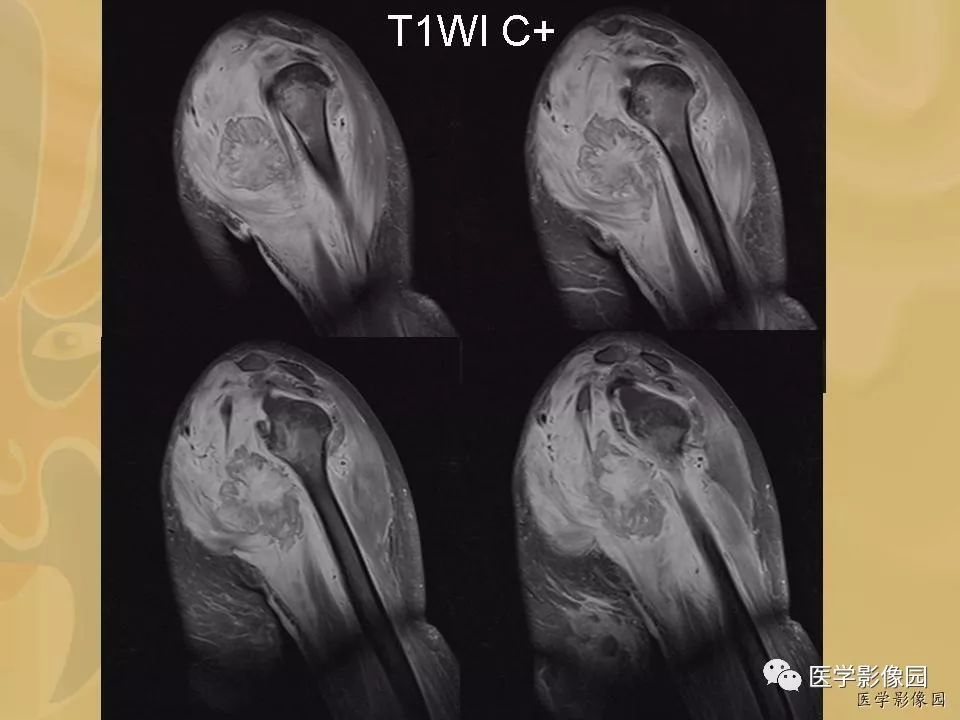 【病例】骨化性肌炎1例X线CT及MR影像表现
