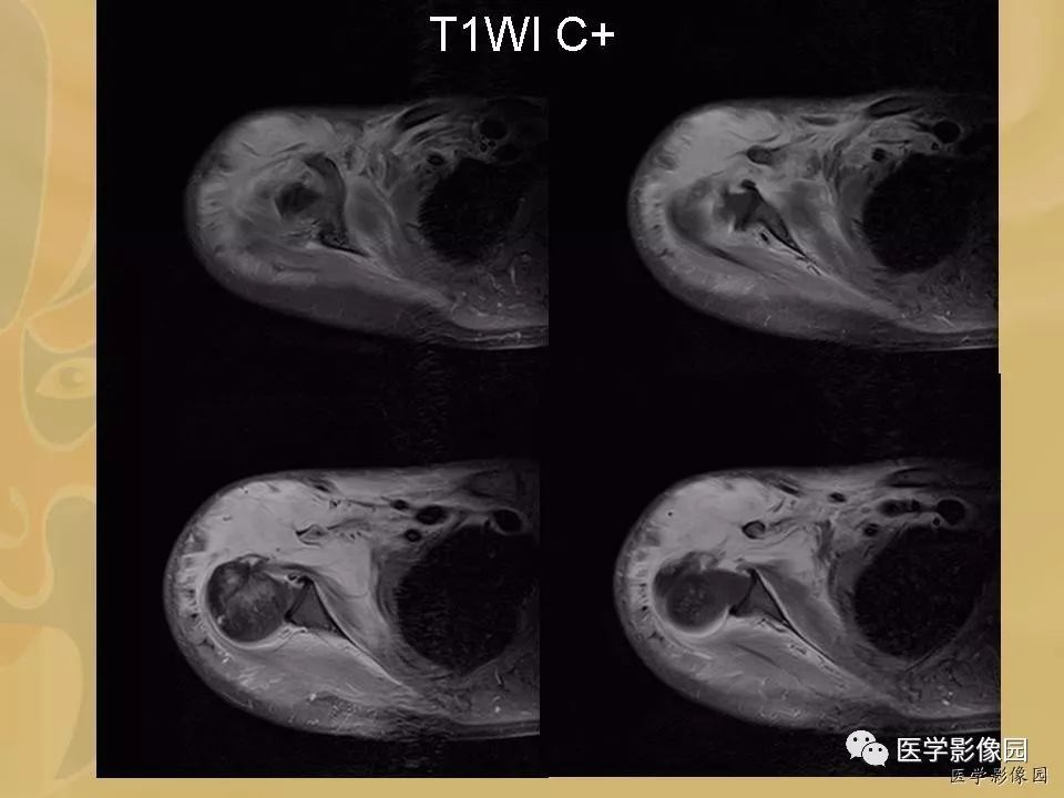 【病例】骨化性肌炎1例X线CT及MR影像表现