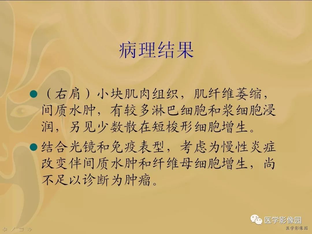 【病例】骨化性肌炎1例X线CT及MR影像表现