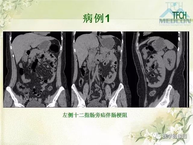 【PPT】肠梗阻MSCT病因诊断