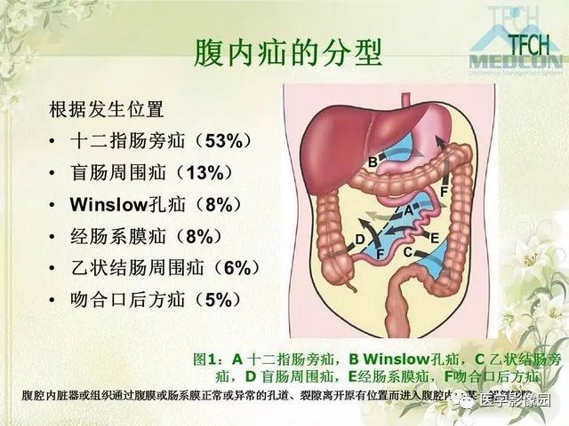 【PPT】肠梗阻MSCT病因诊断
