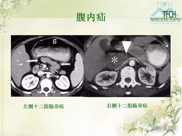 【PPT】肠梗阻MSCT病因诊断