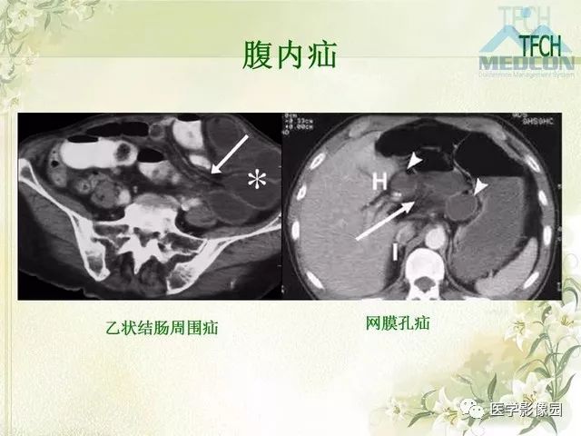 【PPT】肠梗阻MSCT病因诊断