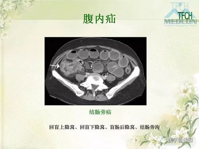 【PPT】肠梗阻MSCT病因诊断