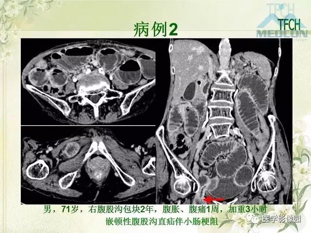 【PPT】肠梗阻MSCT病因诊断