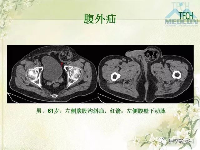 【PPT】肠梗阻MSCT病因诊断