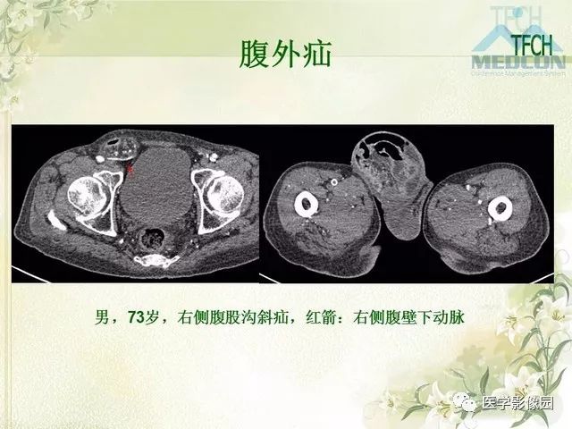 【PPT】肠梗阻MSCT病因诊断