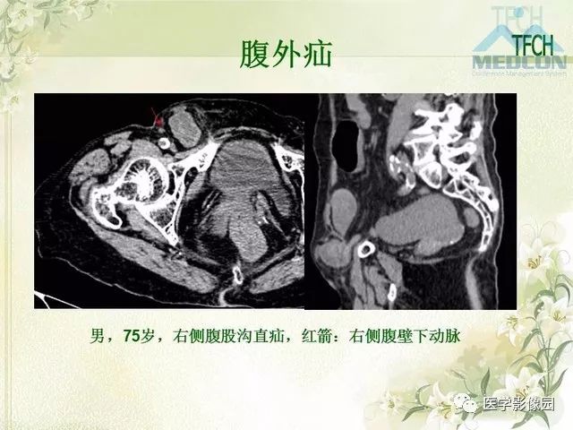 【PPT】肠梗阻MSCT病因诊断