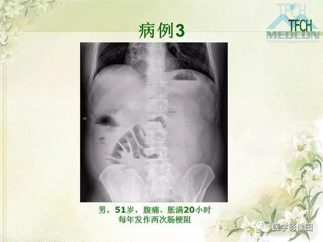 【PPT】肠梗阻MSCT病因诊断