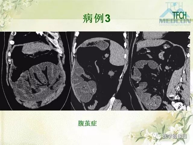 【PPT】肠梗阻MSCT病因诊断