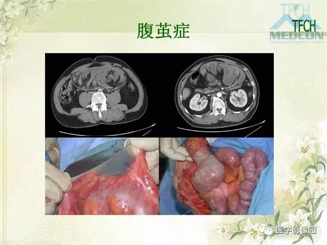 【PPT】肠梗阻MSCT病因诊断
