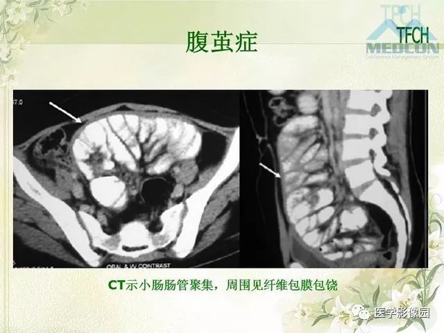【PPT】肠梗阻MSCT病因诊断