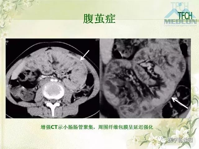 【PPT】肠梗阻MSCT病因诊断