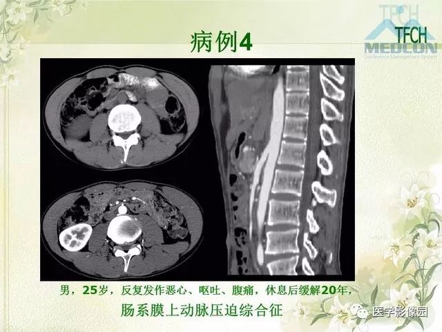 【PPT】肠梗阻MSCT病因诊断