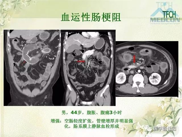 【PPT】肠梗阻MSCT病因诊断