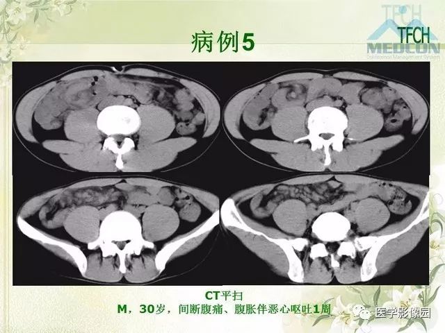 【PPT】肠梗阻MSCT病因诊断