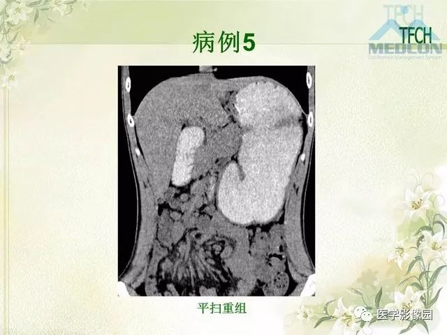 【PPT】肠梗阻MSCT病因诊断