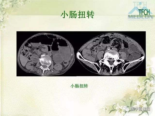 【PPT】肠梗阻MSCT病因诊断