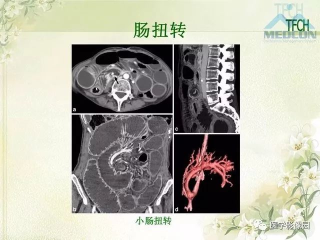 【PPT】肠梗阻MSCT病因诊断