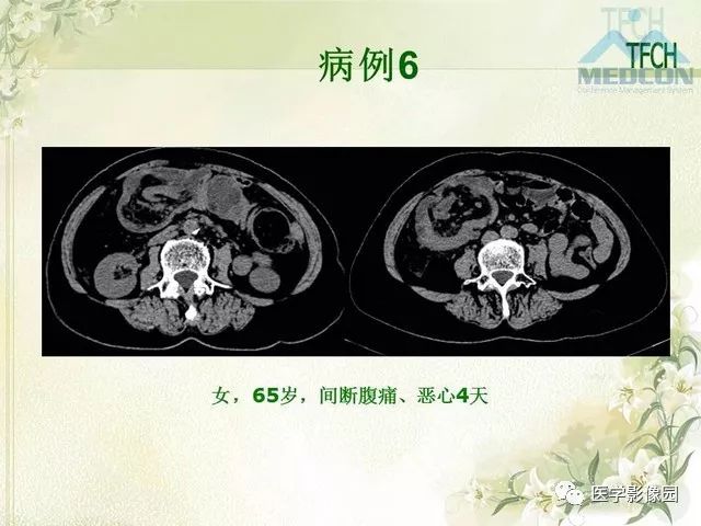 【PPT】肠梗阻MSCT病因诊断