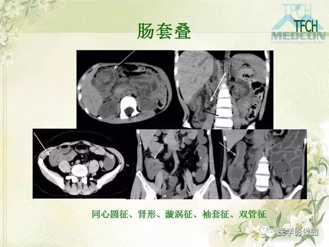 【PPT】肠梗阻MSCT病因诊断