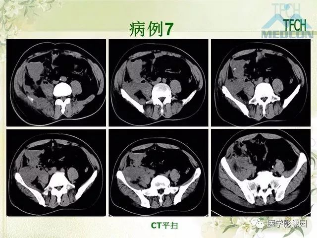 【PPT】肠梗阻MSCT病因诊断