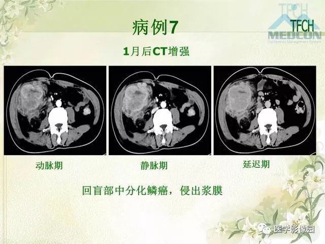 【PPT】肠梗阻MSCT病因诊断