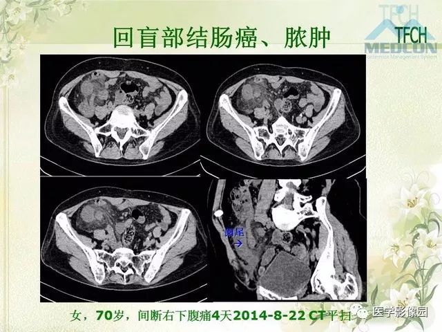 【PPT】肠梗阻MSCT病因诊断