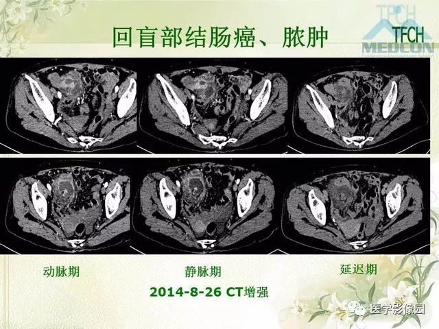 【PPT】肠梗阻MSCT病因诊断