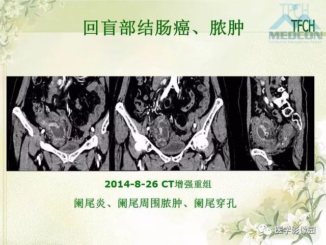 【PPT】肠梗阻MSCT病因诊断