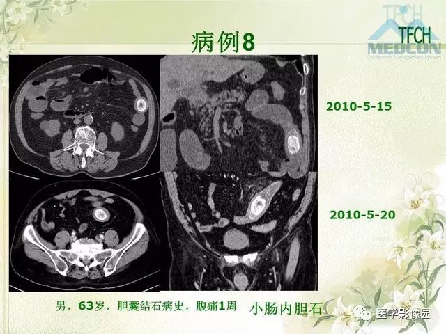 【PPT】肠梗阻MSCT病因诊断