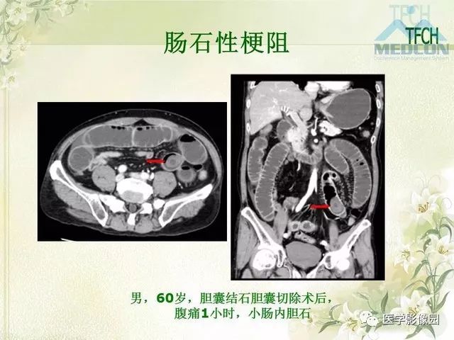 【PPT】肠梗阻MSCT病因诊断