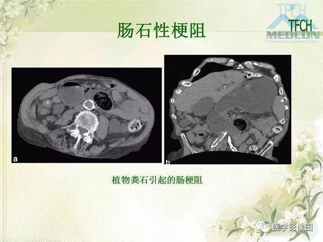 【PPT】肠梗阻MSCT病因诊断