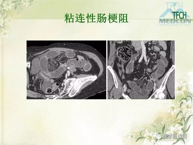 【PPT】肠梗阻MSCT病因诊断