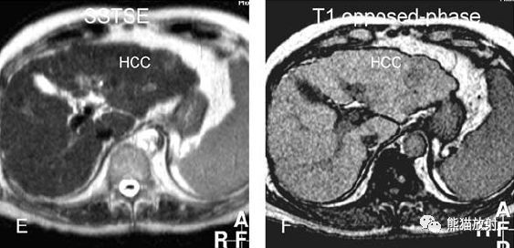 肝硬化之肝细胞癌(HCC)丨多发、肝包膜回缩、弥漫性肝癌、肝内胆管扩张 肝硬化之肝细胞癌(HCC)丨多发、肝包膜回缩、弥漫性肝癌、肝内胆管扩张