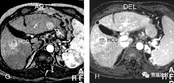 肝硬化之肝细胞癌(HCC)丨多发、肝包膜回缩、弥漫性肝癌、肝内胆管扩张 肝硬化之肝细胞癌(HCC)丨多发、肝包膜回缩、弥漫性肝癌、肝内胆管扩张