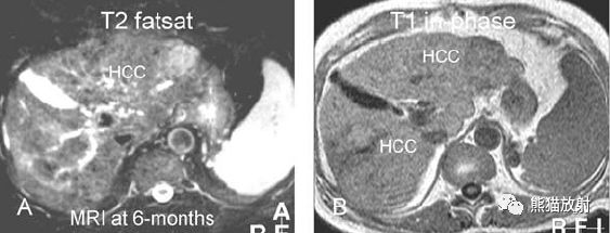 肝硬化之肝细胞癌(HCC)丨多发、肝包膜回缩、弥漫性肝癌、肝内胆管扩张 肝硬化之肝细胞癌(HCC)丨多发、肝包膜回缩、弥漫性肝癌、肝内胆管扩张