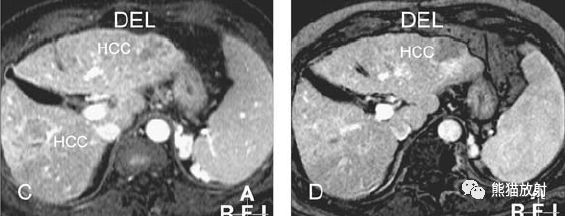 肝硬化之肝细胞癌(HCC)丨多发、肝包膜回缩、弥漫性肝癌、肝内胆管扩张 肝硬化之肝细胞癌(HCC)丨多发、肝包膜回缩、弥漫性肝癌、肝内胆管扩张