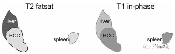 肝硬化之肝细胞癌(HCC)丨多发、肝包膜回缩、弥漫性肝癌、肝内胆管扩张 肝硬化之肝细胞癌(HCC)丨多发、肝包膜回缩、弥漫性肝癌、肝内胆管扩张