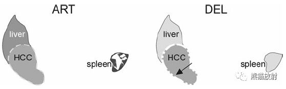 肝硬化之肝细胞癌(HCC)丨多发、肝包膜回缩、弥漫性肝癌、肝内胆管扩张 肝硬化之肝细胞癌(HCC)丨多发、肝包膜回缩、弥漫性肝癌、肝内胆管扩张