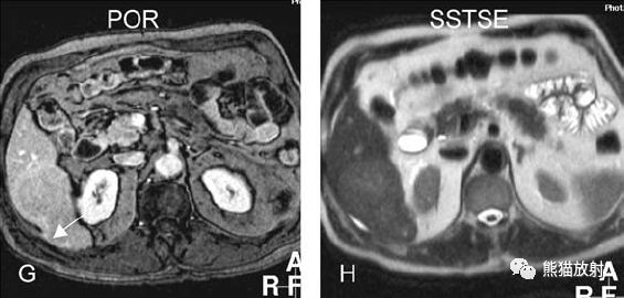 肝硬化之肝细胞癌(HCC)丨多发、肝包膜回缩、弥漫性肝癌、肝内胆管扩张 肝硬化之肝细胞癌(HCC)丨多发、肝包膜回缩、弥漫性肝癌、肝内胆管扩张