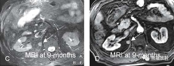 肝硬化之肝细胞癌(HCC)丨多发、肝包膜回缩、弥漫性肝癌、肝内胆管扩张 肝硬化之肝细胞癌(HCC)丨多发、肝包膜回缩、弥漫性肝癌、肝内胆管扩张