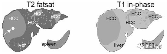 肝硬化之肝细胞癌(HCC)丨多发、肝包膜回缩、弥漫性肝癌、肝内胆管扩张 肝硬化之肝细胞癌(HCC)丨多发、肝包膜回缩、弥漫性肝癌、肝内胆管扩张