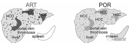 肝硬化之肝细胞癌(HCC)丨多发、肝包膜回缩、弥漫性肝癌、肝内胆管扩张 肝硬化之肝细胞癌(HCC)丨多发、肝包膜回缩、弥漫性肝癌、肝内胆管扩张