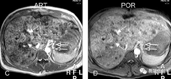 肝硬化之肝细胞癌(HCC)丨多发、肝包膜回缩、弥漫性肝癌、肝内胆管扩张 肝硬化之肝细胞癌(HCC)丨多发、肝包膜回缩、弥漫性肝癌、肝内胆管扩张